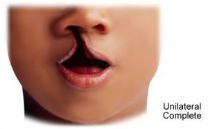 Bibir Sumbing Unilateral Complete