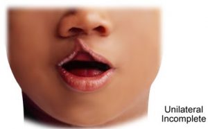 Bibir Sumbing Unilateral Incomplete