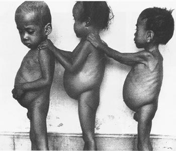 malnutrisi
