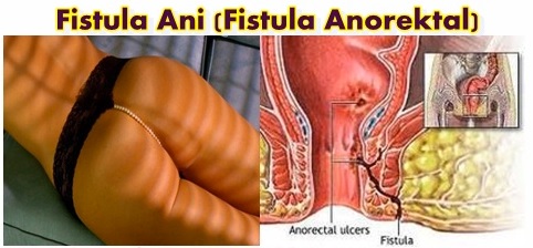 Apakah penyakit fistula ani berbahaya