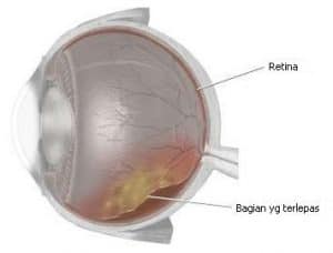 ablasio retina