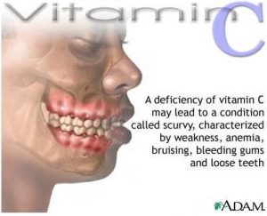 kurang vitamin c