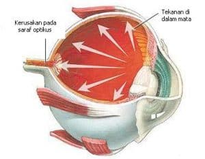 penyebab glaukoma