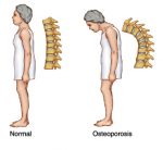 penyebab osteoporosis