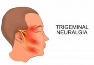 neuralgia-trigeminal1
