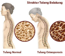 gejala osteoporosis
