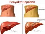 penyebab hepatitis
