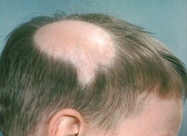 Alopecia penyakit apa