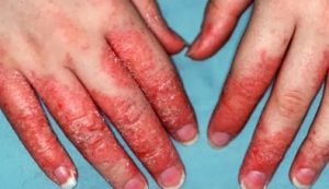 jenis penyakit kulit - Eksim