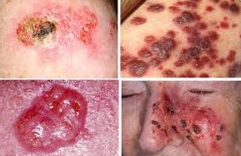 jenis penyakit kulit - kanker kulit