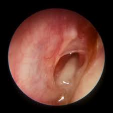infeksi telinga