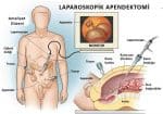 Apendektomi