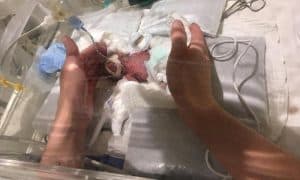 Ini Dia Bayi Paling Kecil di Dunia, Lahir di Jepang dengan Bobot 268 Gram