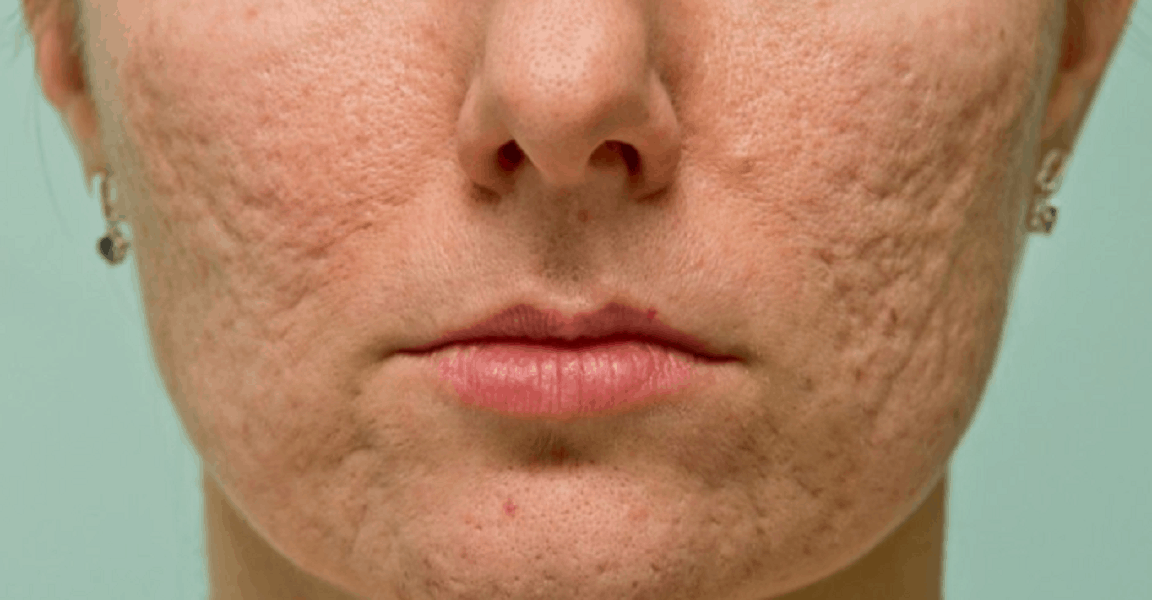 cara menghilangkan pori pori wajah secara alami dan cepat
