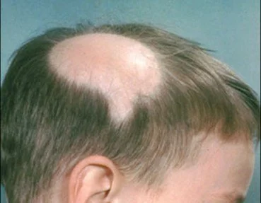 4 Penyebab dan Cara Mengatasi Penyakit Alopecia Universalis