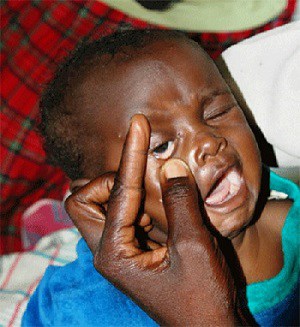 Gejala Anemia pada Anak Yang Bisa Menyebabkan Stunting