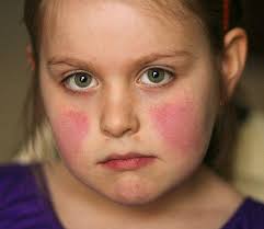 Penyakit Lupus pada Anak