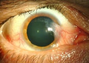 Penyakit Mata Glaukoma