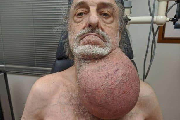 Tumor Sebesar Kepala pada Leher Pria 81 Tahun Ini Berhasil Diangkat